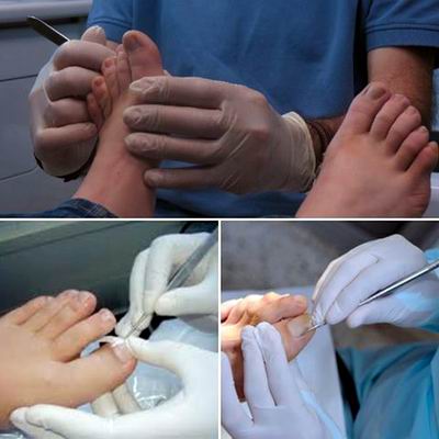 Podologo, revisando los callos en los pies 