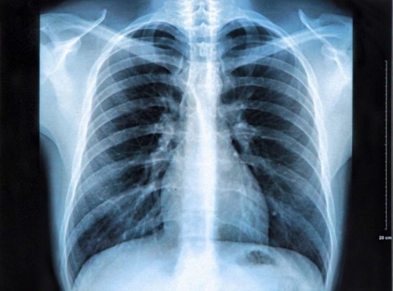 Cáncer de pulmón