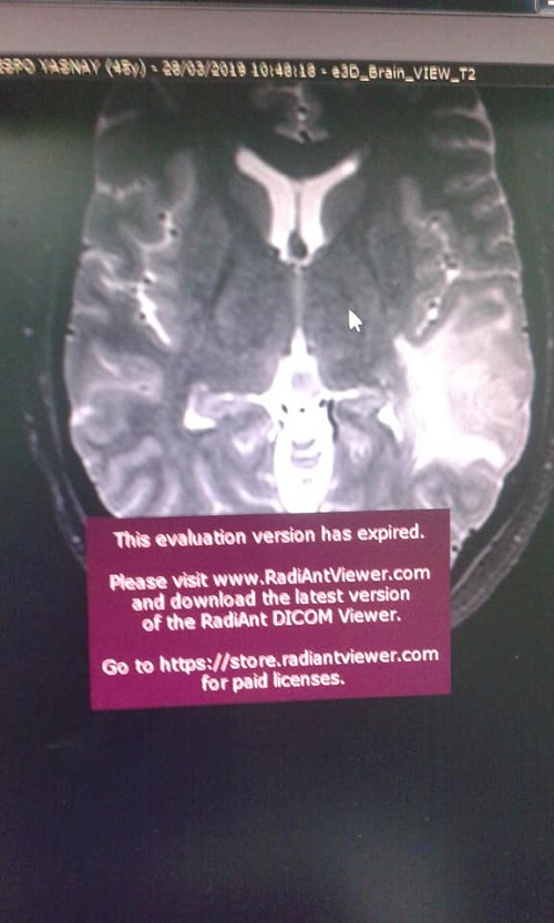 Novedoso proceder: Mapeo cerebral del lenguaje en paciente despierto